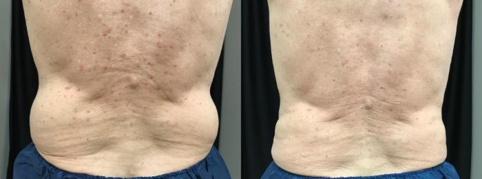 Before & After CoolSculpting® Case 316 Back View in Ann Arbor, MI