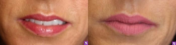 Before & After Dermal Fillers Case 317 Front View in Ann Arbor, MI