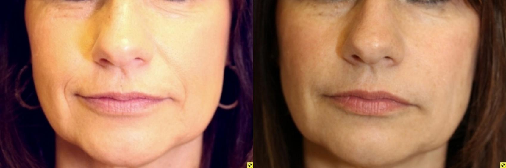 Before & After Dermal Fillers Case 318 Front View in Ann Arbor, MI