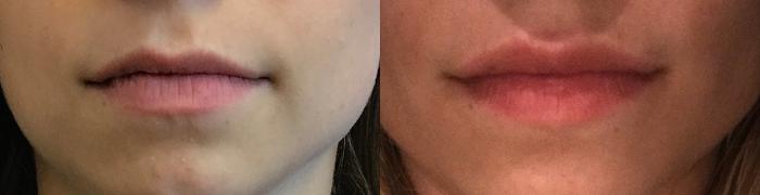 Before & After Dermal Fillers Case 319 Front View in Ypsilanti, MI