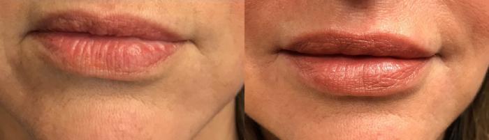 Before & After Dermal Fillers Case 320 Front View in Ann Arbor, MI