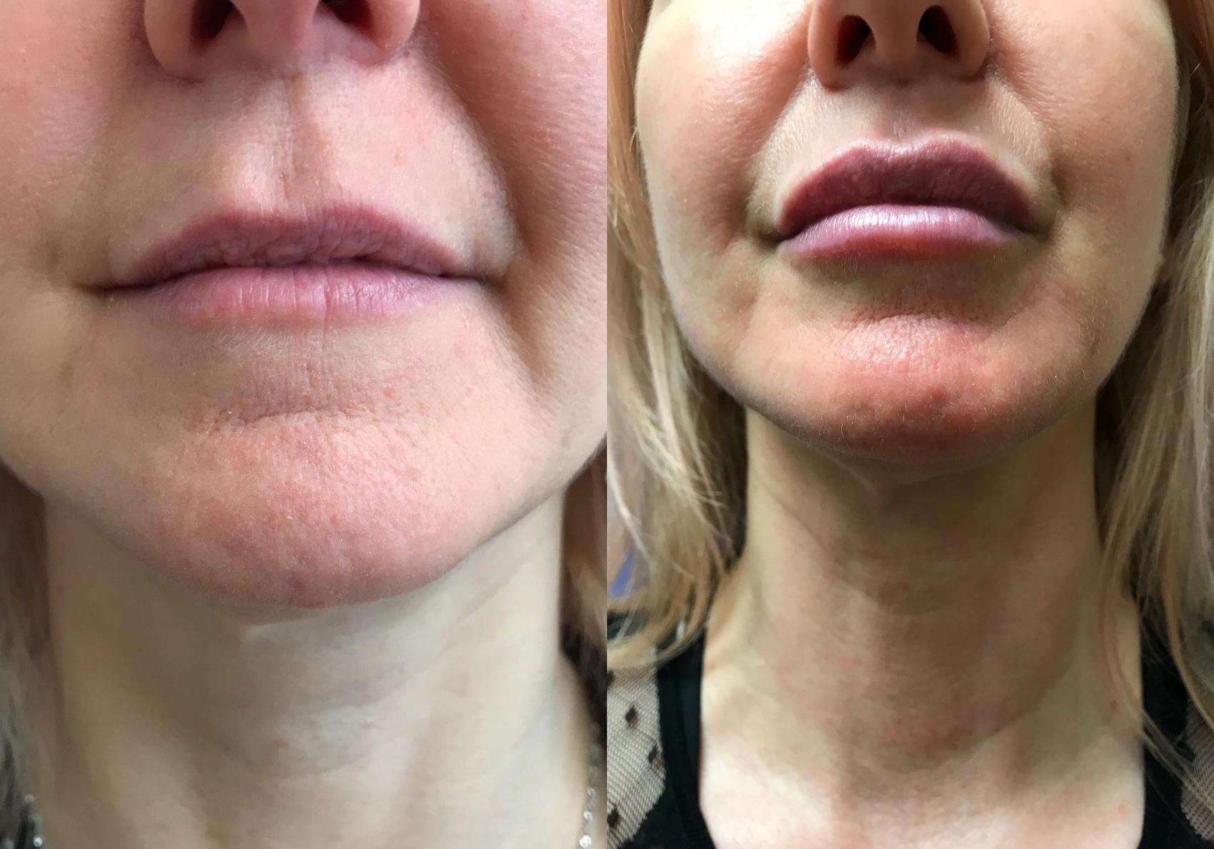 Before & After Dermal Fillers Case 322 Front View in Ypsilanti, MI