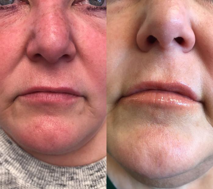 Before & After Dermal Fillers Case 323 Front View in Ann Arbor, MI
