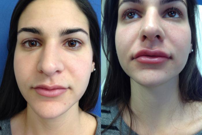 Before & After Dermal Fillers Case 324 Front View in Ann Arbor, MI