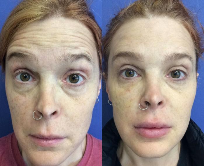 Before & After Dermal Fillers Case 325 Front View in Ann Arbor, MI