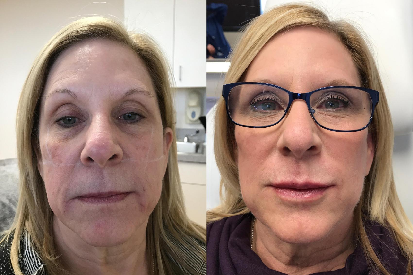 Before & After Dermal Fillers Case 326 Front View in Ypsilanti, MI