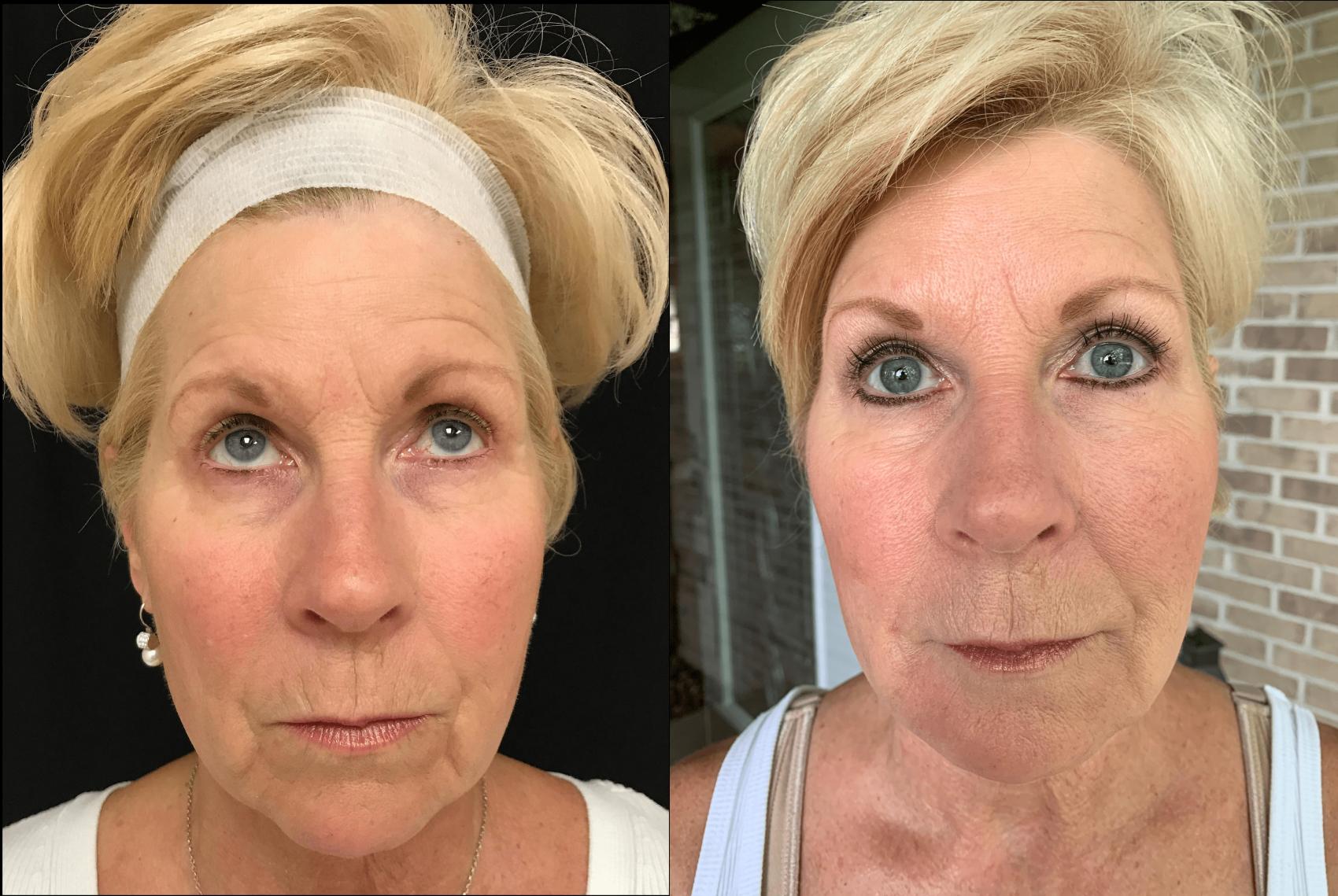 Before & After Dermal Fillers Case 327 Front View in Ann Arbor, MI