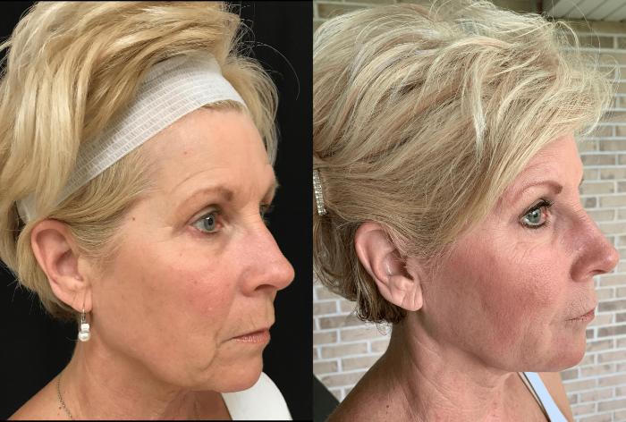Before & After Dermal Fillers Case 327 Right Oblique View in Ann Arbor, MI