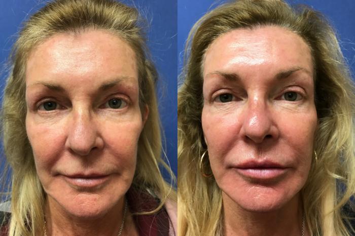 Before & After Dermal Fillers Case 363 Front View in Ann Arbor, MI