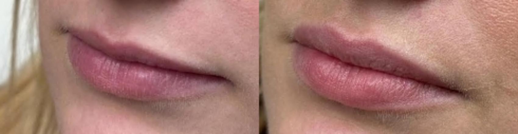 Before & After Dermal Fillers Case 441 Left Side View in Ann Arbor, MI
