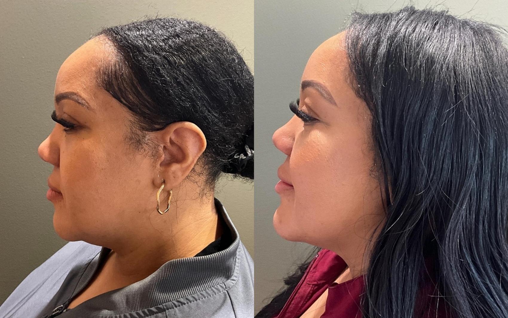 Before & After Dermal Fillers Case 453 Left Side View in Ann Arbor, MI
