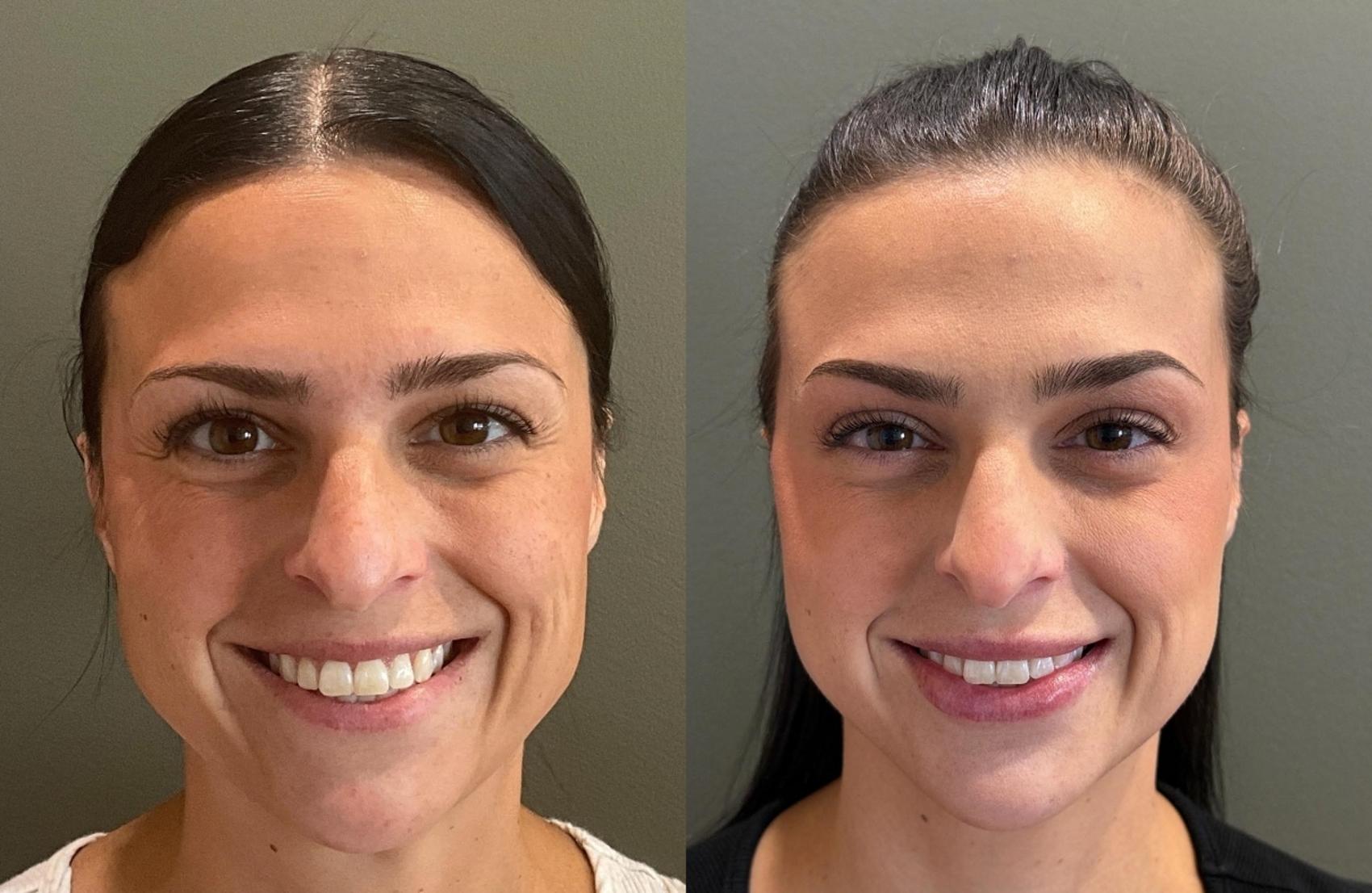 Before & After Dermal Fillers Case 455 Front View in Ann Arbor, MI