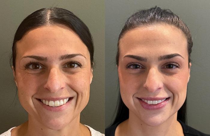 Before & After Dermal Fillers Case 455 Front View in Ann Arbor, MI
