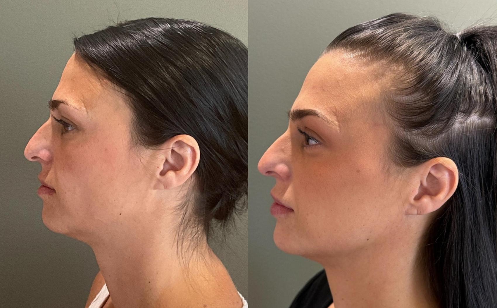 Before & After Dermal Fillers Case 455 Left Side View in Ann Arbor, MI