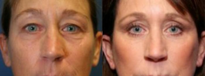 Before & After Eyelid Surgery Case 165 Front View in Ann Arbor, MI