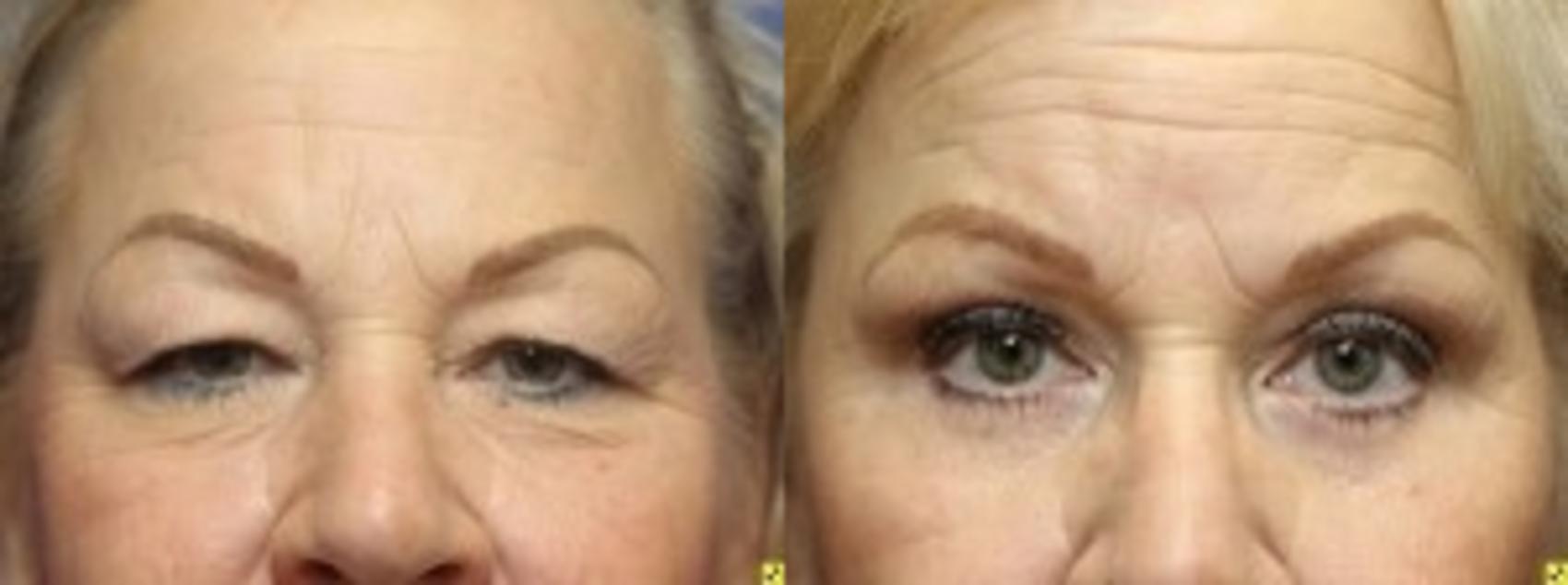 Before & After Eyelid Surgery Case 166 Front View in Ypsilanti, MI