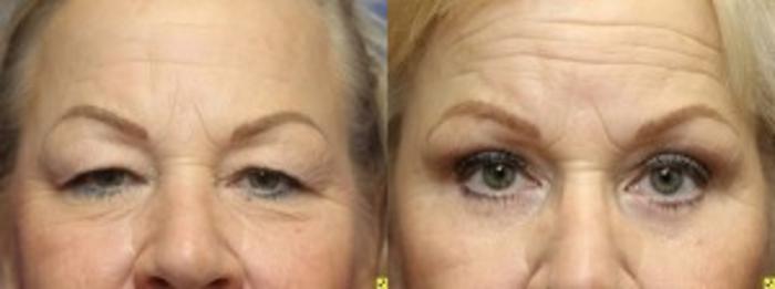 Before & After Eyelid Surgery Case 166 Front View in Ann Arbor, MI
