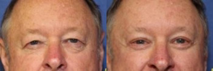 Before & After Eyelid Surgery Case 167 Front View in Ann Arbor, MI