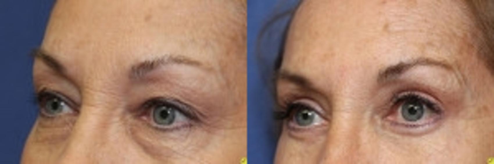Before & After Eyelid Surgery Case 168 Left Oblique View in Ann Arbor, MI