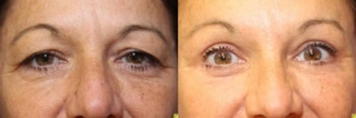 Before & After Eyelid Surgery Case 169 Front View in Ypsilanti, MI