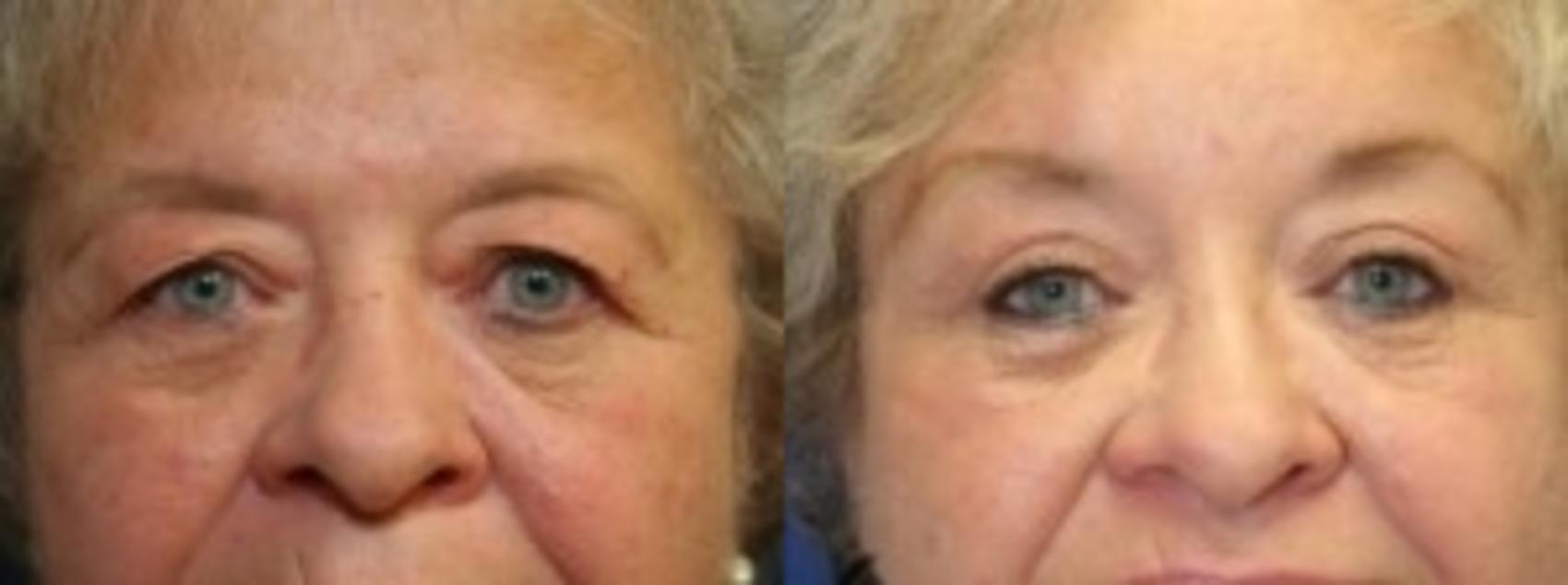 Before & After Eyelid Surgery Case 170 Front View in Ypsilanti, MI