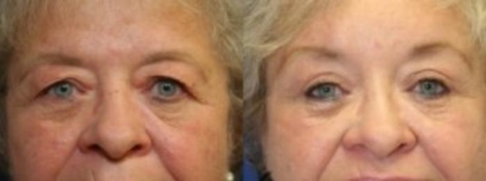 Before & After Eyelid Surgery Case 170 Front View in Ypsilanti, MI
