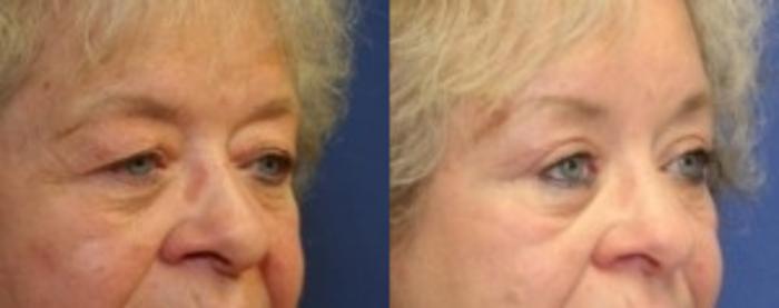 Before & After Eyelid Surgery Case 170 Right Oblique View in Ypsilanti, MI
