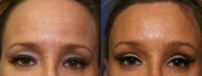 Before & After Eyelid Surgery Case 171 Front View in Ann Arbor, MI