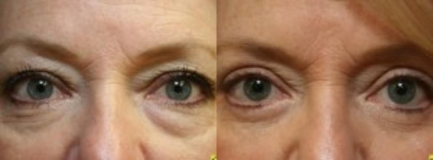 Before & After Eyelid Surgery Case 172 Front View in Ypsilanti, MI