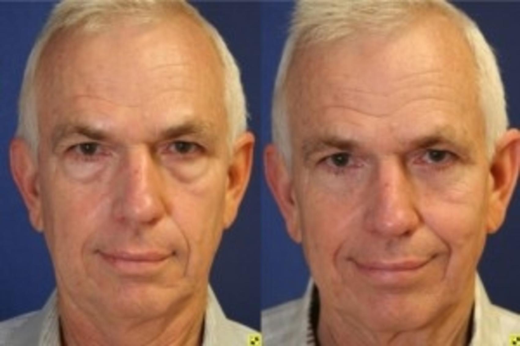 Before & After Eyelid Surgery Case 173 Front 2 View in Ann Arbor, MI