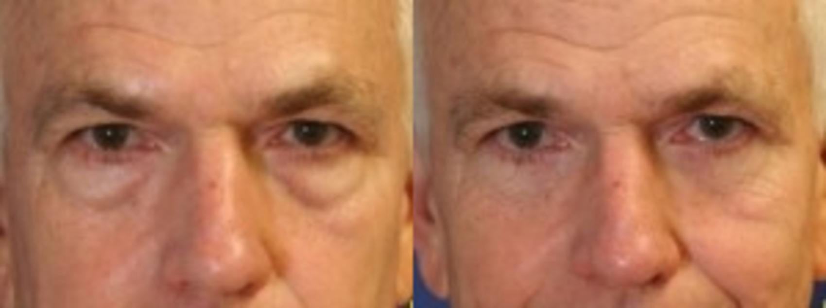 Before & After Eyelid Surgery Case 173 Front View in Ann Arbor, MI