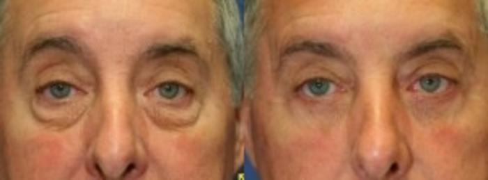 Before & After Eyelid Surgery Case 174 Front View in Ann Arbor, MI