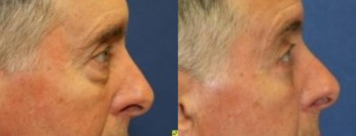 Before & After Eyelid Surgery Case 174 Right Side View in Ann Arbor, MI