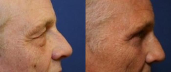 Before & After Eyelid Surgery Case 175 Right Side View in Ann Arbor, MI