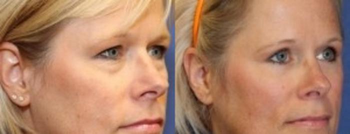 Before & After Eyelid Surgery Case 178 Right Oblique View in Ann Arbor, MI