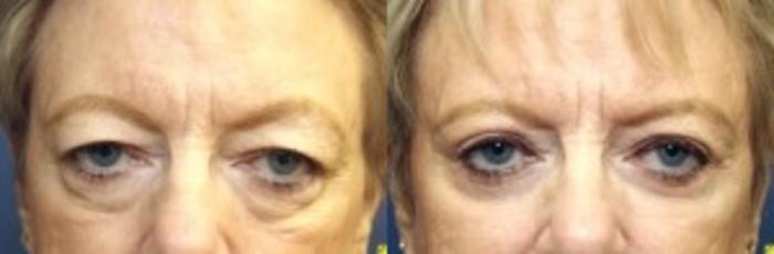 Before & After Eyelid Surgery Case 179 Front View in Ann Arbor, MI