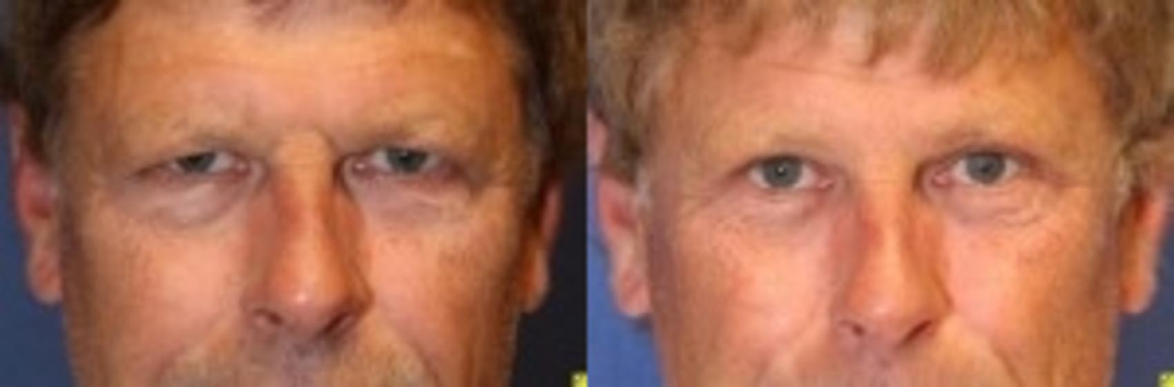 Before & After Eyelid Surgery Case 180 Front View in Ann Arbor, MI