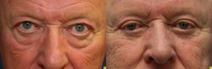 Before & After Eyelid Surgery Case 181 Front View in Ann Arbor, MI