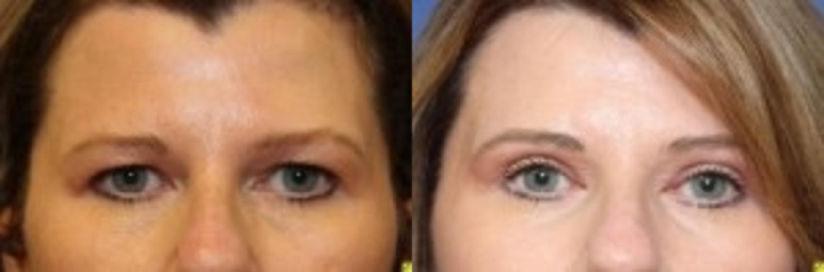 Before & After Eyelid Surgery Case 182 Front View in Ypsilanti, MI