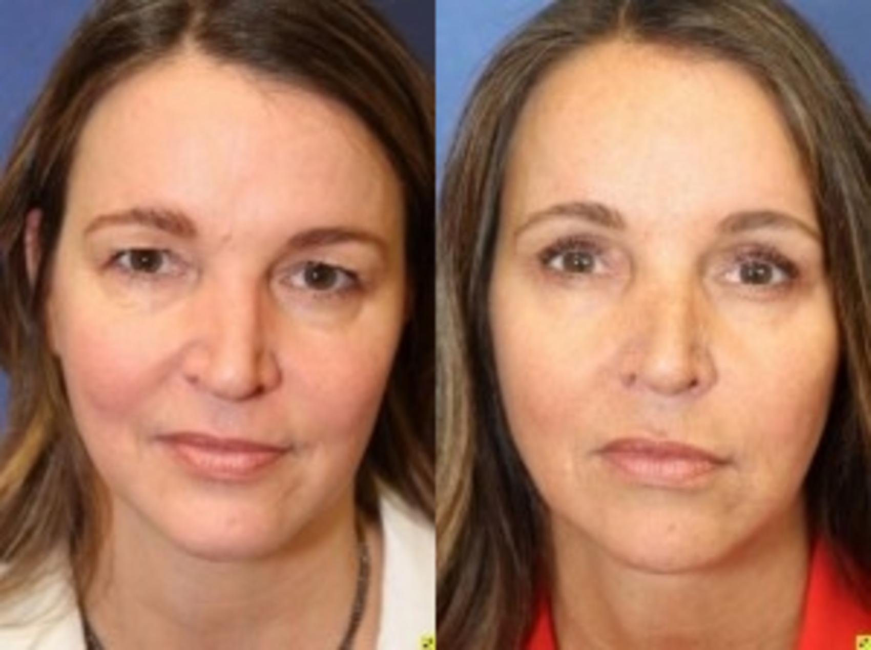 Before & After Eyelid Surgery Case 183 Front View in Ann Arbor, MI