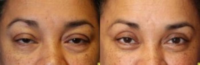 Before & After Eyelid Surgery Case 184 Front View in Ypsilanti, MI