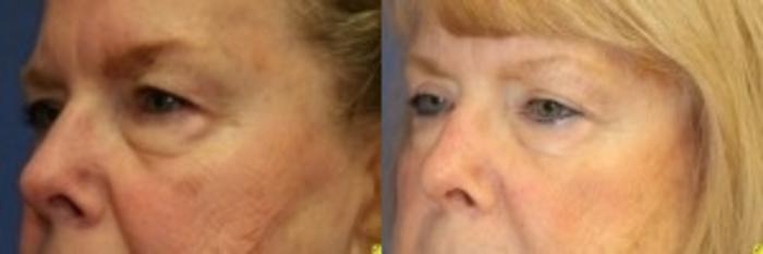 Before & After Eyelid Surgery Case 185 Left Oblique View in Ann Arbor, MI