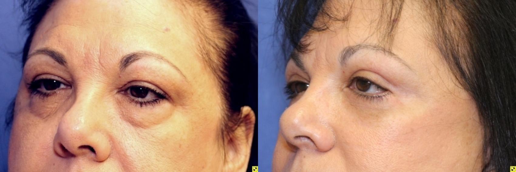 Before & After Eyelid Surgery Case 186 Left Oblique View in Ann Arbor, MI