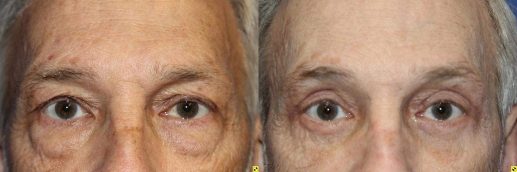 Before & After Eyelid Surgery Case 187 Front View in Ann Arbor, MI