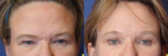 Before & After Eyelid Surgery Case 188 Front View in Ypsilanti, MI