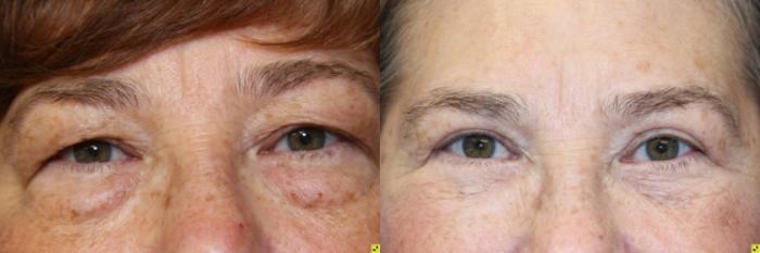 Before & After Eyelid Surgery Case 189 Front View in Ann Arbor, MI