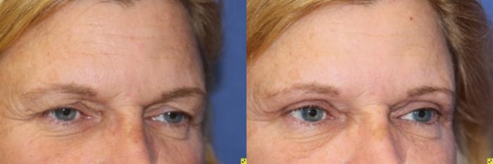 Before & After Eyelid Surgery Case 190 Right Oblique View in Ann Arbor, MI
