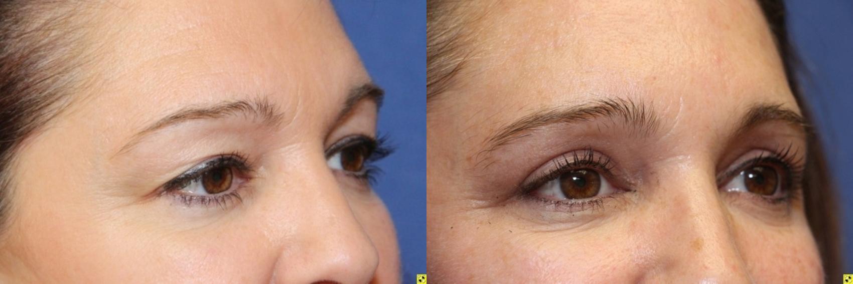Before & After Eyelid Surgery Case 191 Right Oblique View in Ann Arbor, MI