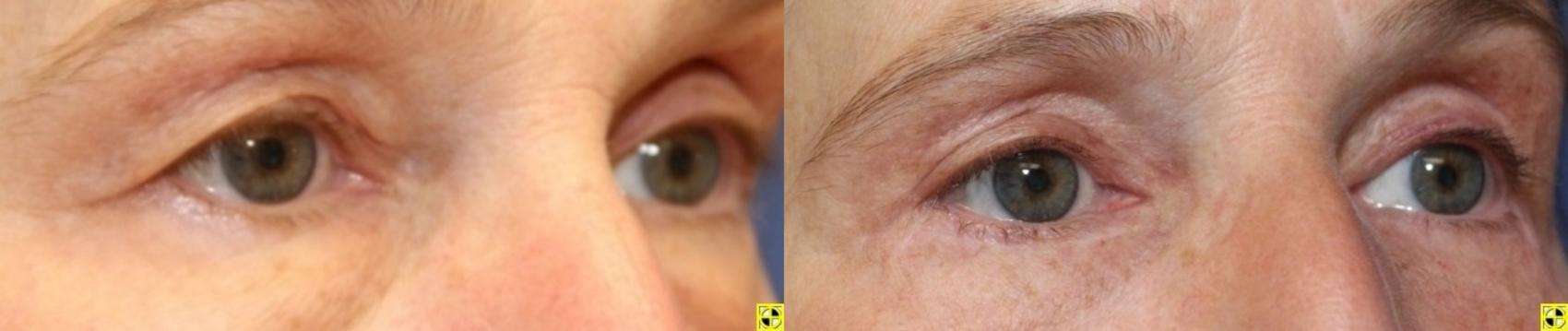 Before & After Eyelid Surgery Case 192 Right Oblique View in Ypsilanti, MI