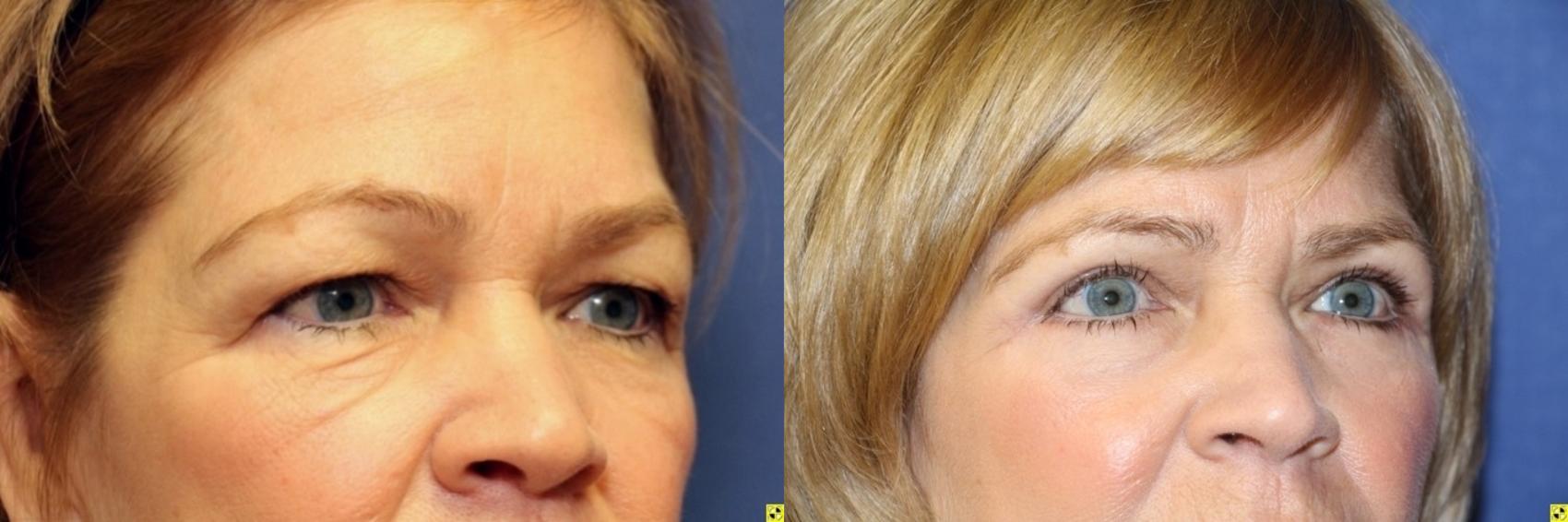 Before & After Eyelid Surgery Case 193 Right Oblique View in Ann Arbor, MI